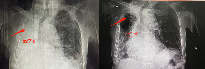 治疗前后CT检查对比图.png